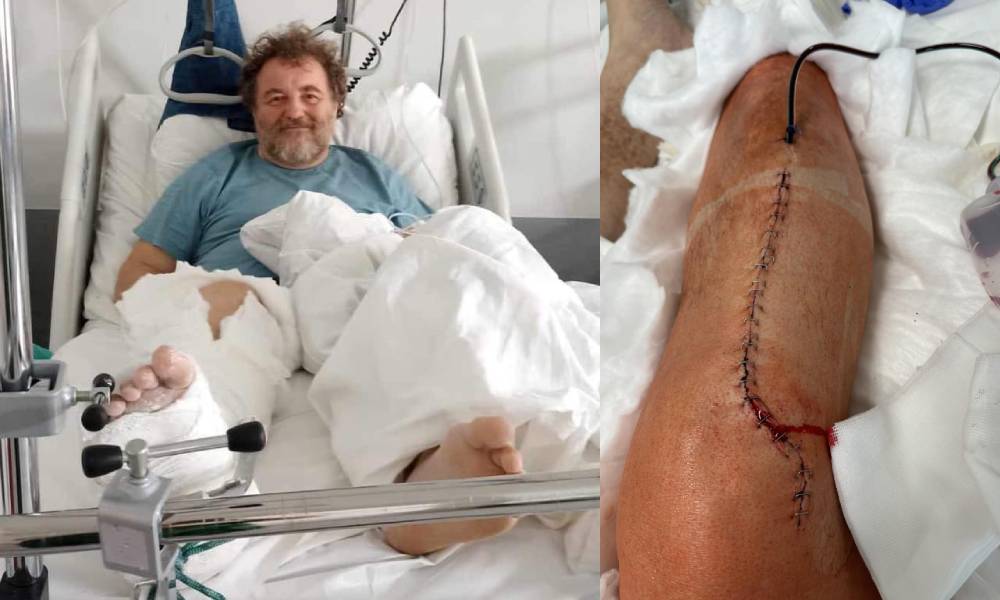 Błażej Małczyński doznał skomplikowanego złamania nogi. Wciąż przebywa w szpitalu i czekają go jeszcze długie miesiące rehabilitacji Fot. arch. prywatne